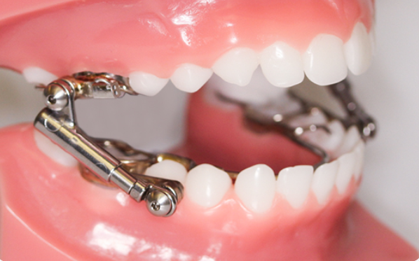 Flossing With Braces